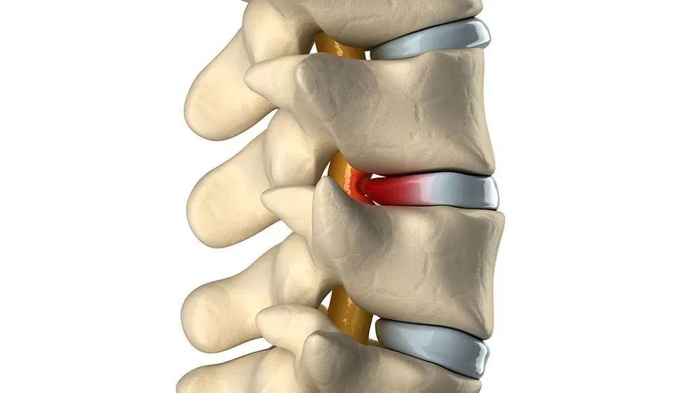 Spinal disc treatment for back pain at Ishwaryam Spine & Joint Clinic.
                                